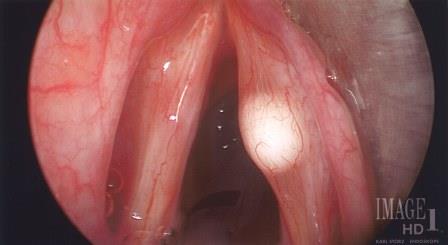 Intrafold Cyst