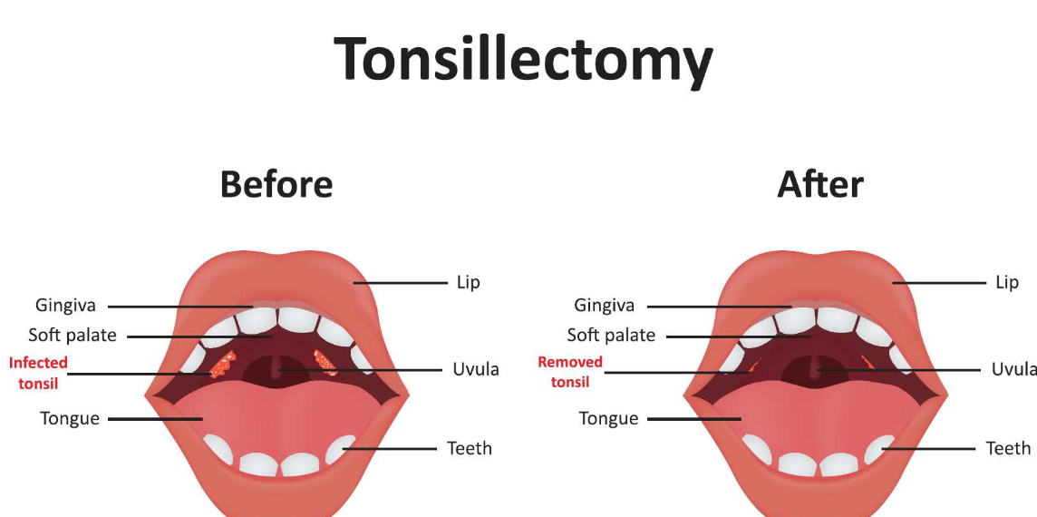 Tonsil Infection After Removal