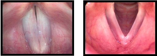 Paradoxical Vocal Fold Movement (PVFM)