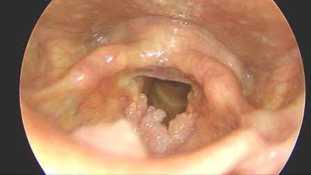 papilloma voice symptoms