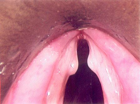 A laryngeal electromyography (EMG) helps our voice doctors evaluate voice muscles