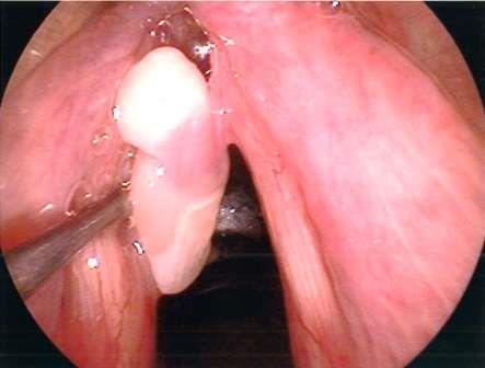 A laryngeal electromyography (EMG) helps our voice doctors evaluate voice muscles